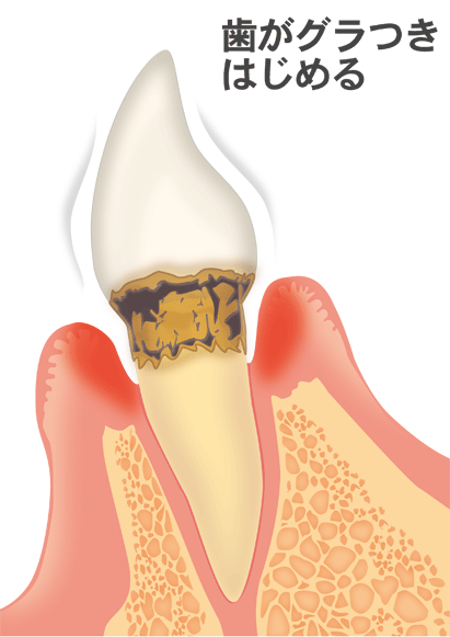 歯がぐらつき始める