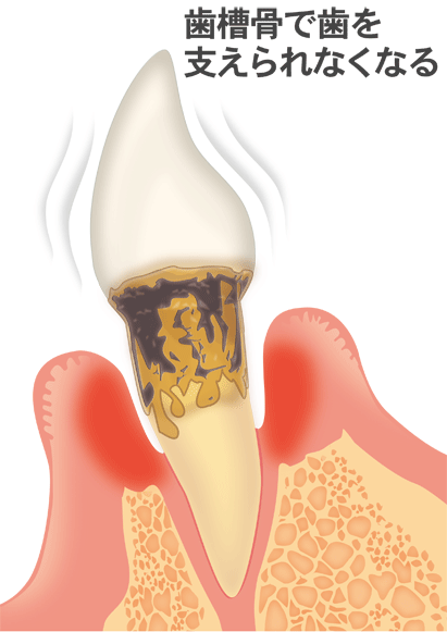 歯槽骨で歯を支えられなくなる